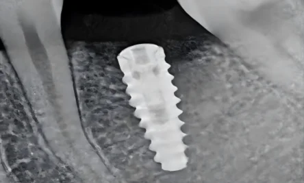 tooth xray